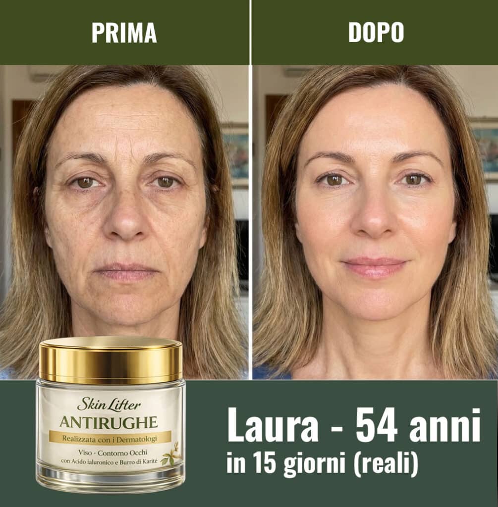 Prima e dopo trattamento viso con SkinLifter Antirughe.