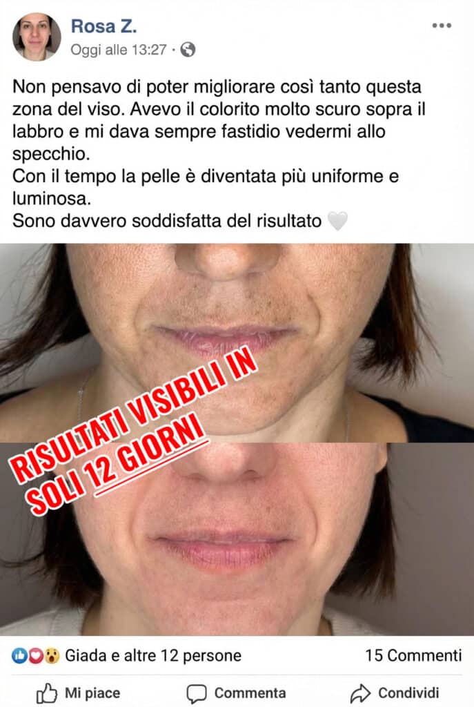 Prima e dopo trattamento viso con miglioramenti evidenti.