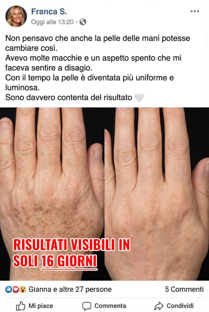 Prima e dopo il trattamento della pelle delle mani, pelle più liscia e luminosa.