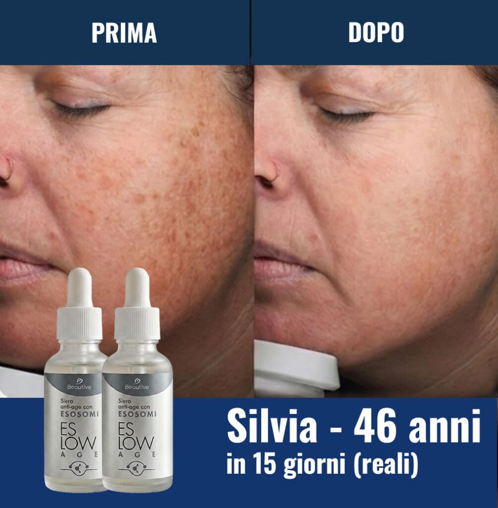 Prima e dopo trattamento viso anti-età con siero ESOSOMI.