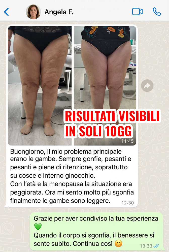 Prima e dopo trattamento gambe con cellulite e ritenzione.