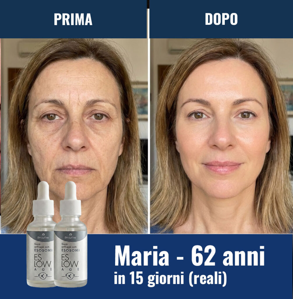 Prima e dopo trattamento viso Maria 62 anni in 15 giorni.