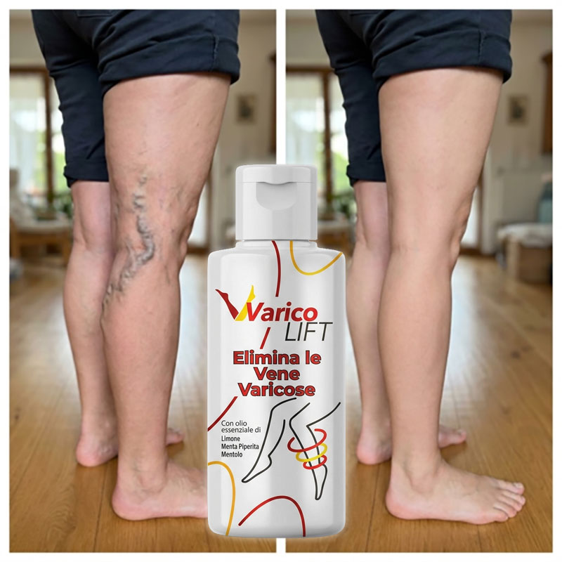 Prodotto Varicolift per eliminare vene varicose sulle gambe.