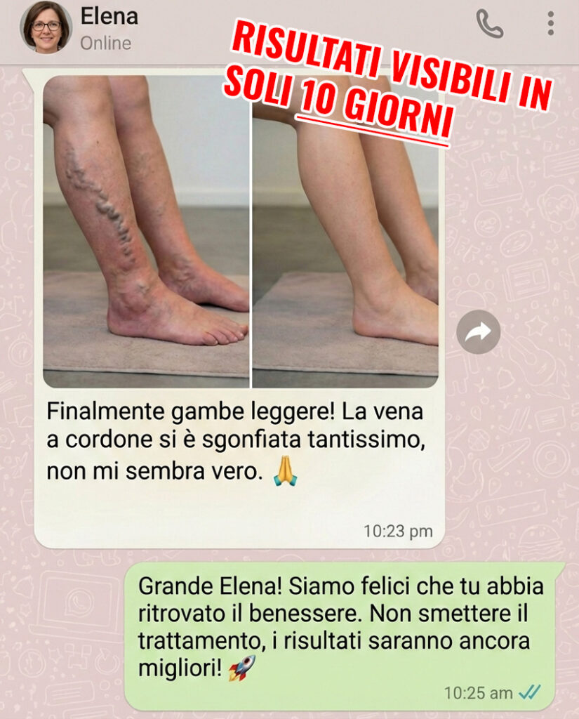 Prima e dopo trattamento vene varicose gambe.