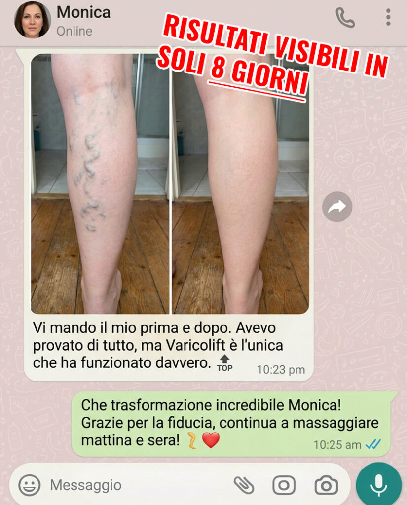 Prima e dopo trattamento Varicolift sulle gambe.