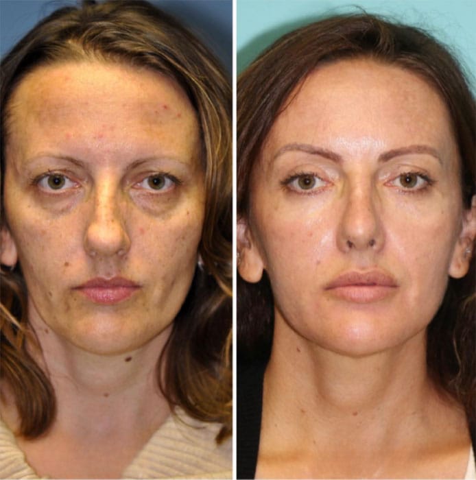 Prima e dopo trattamento Crio Age Eyes per ridurre le rughe e le occhiaie.
