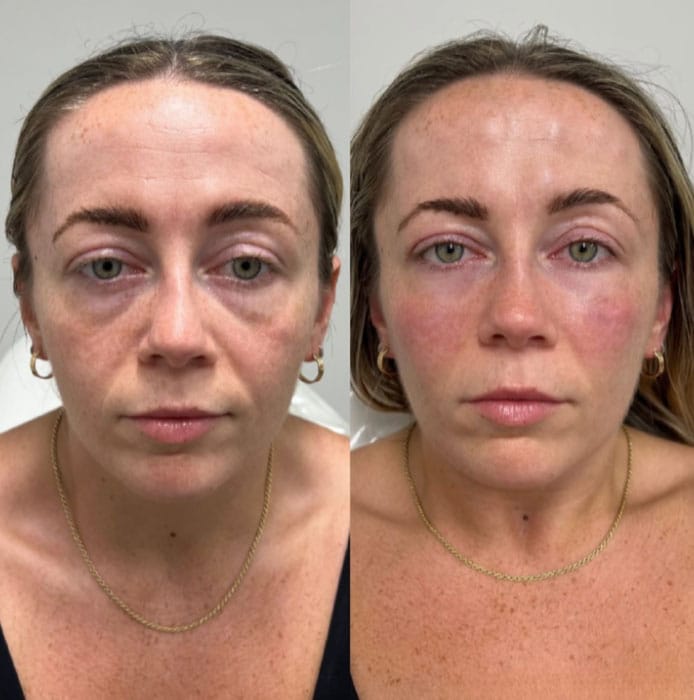 Prima e dopo trattamento Crio Age Eyes per ridurre le occhiaie.