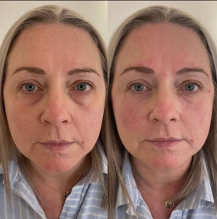 Prima e dopo l'uso di Crio Age Eyes per le occhiaie.