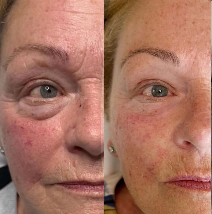Miglioramento visibile della pelle intorno agli occhi con Crio Age Eyes.