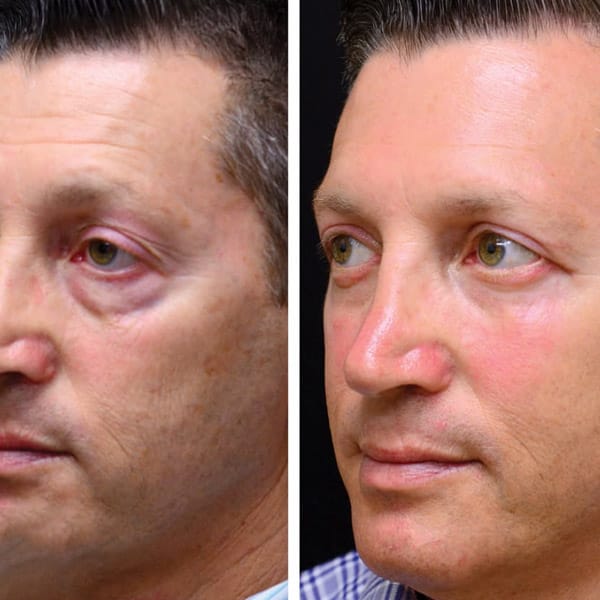 Trattamento anti-età per occhi con Crio Age Eyes Uomo.