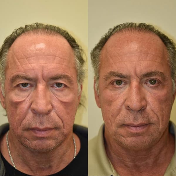 Prima e dopo trattamento Crio Age Eyes su uomo di mezza età.