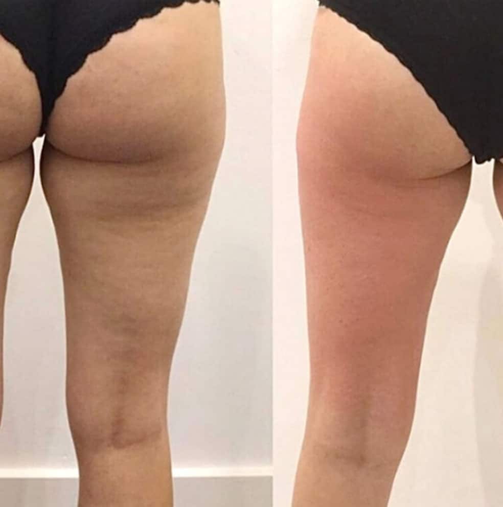 Prima e dopo il trattamento della cellulite sulle cosce.
