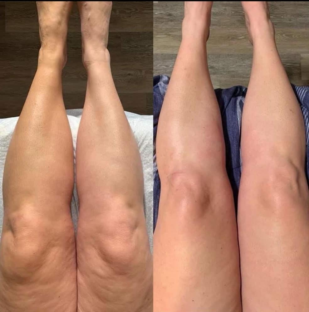 Prima e dopo trattamento per la pelle delle gambe.