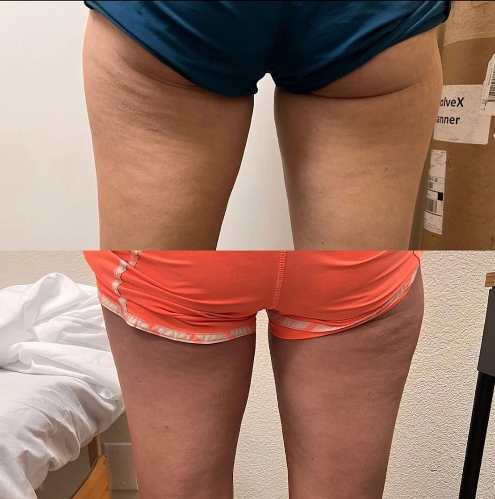 Cicatrici sulla pelle delle gambe in evidenza.