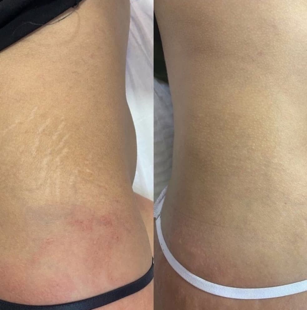 Prima e dopo trattamento per cicatrici sulla pelle.