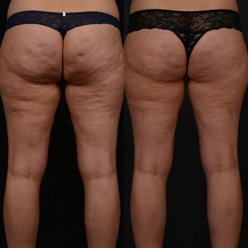 Prima e dopo trattamento cellulite sulle gambe.