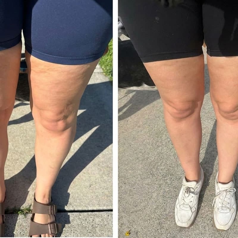 Prima e dopo trattamento per migliorare la circolazione delle gambe.