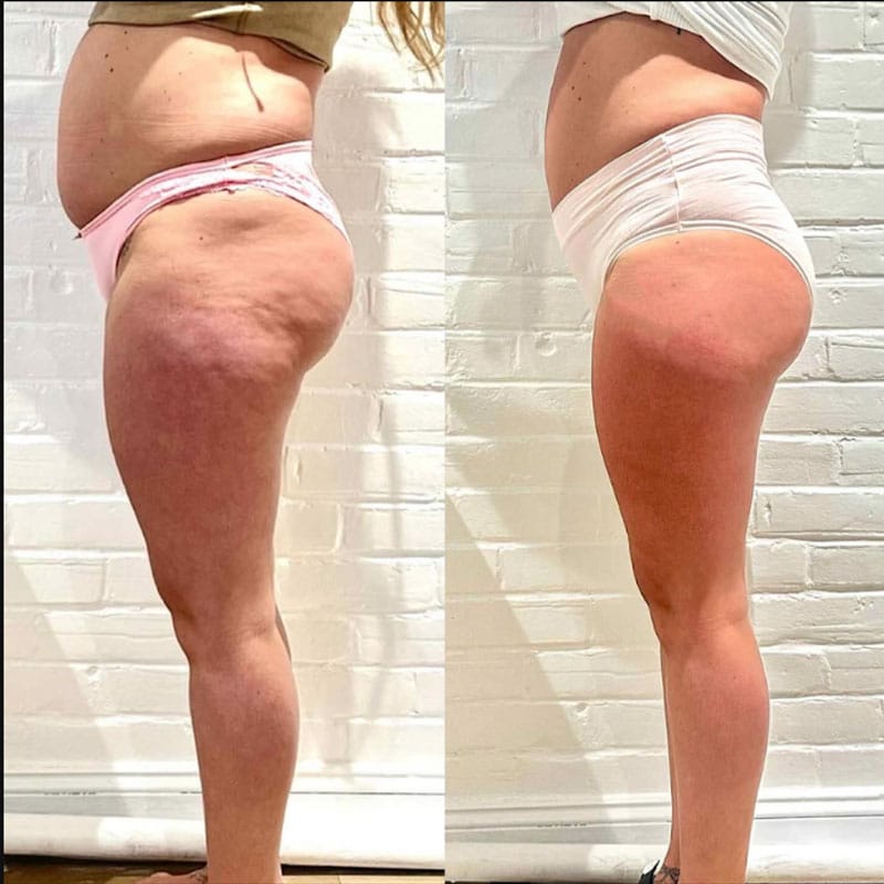 Prima e dopo il trattamento della pelle e tonificazione delle gambe.