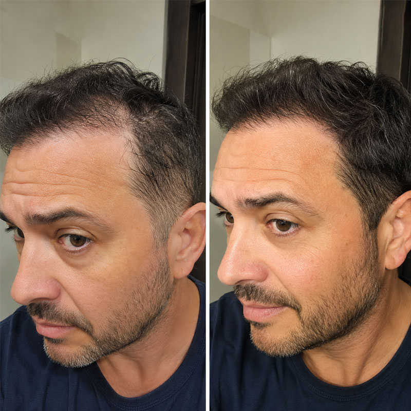 Prima e dopo trattamento tricorosmarinus per capelli.
