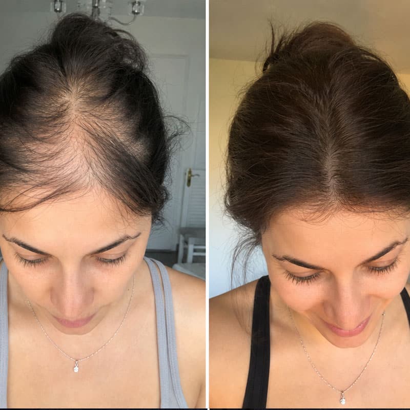 Prima e dopo il trattamento con Tricorosmarinus per la crescita dei capelli.