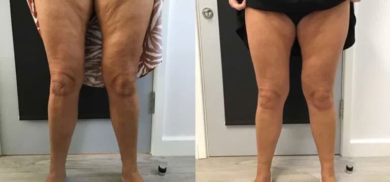 Eslow Age gambe: miglioramento visibile delle gambe.