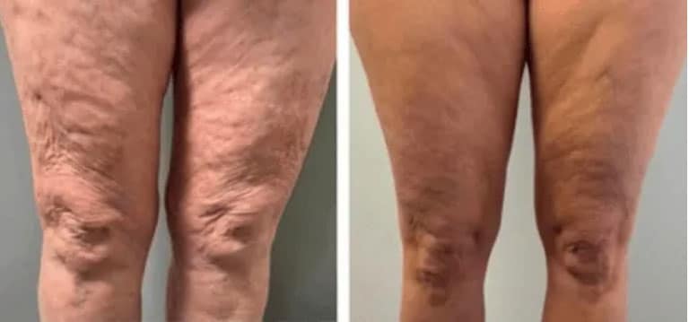 Prima e dopo trattamento Eslow Age gambe, pelle più liscia.