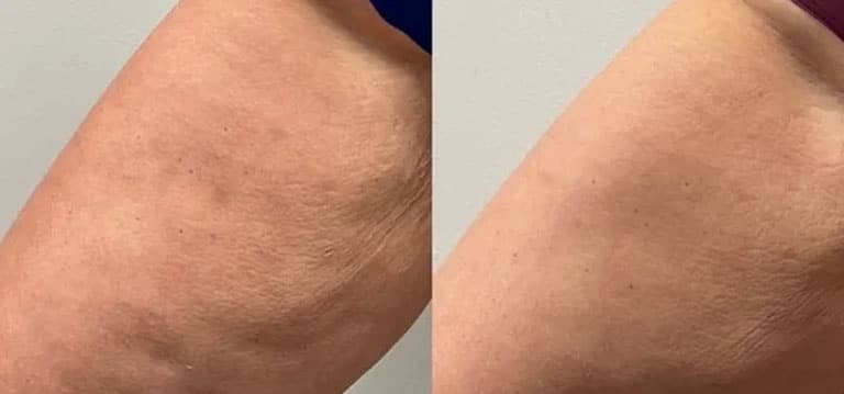 Trattamento naturale per gambe con Eslow Age, riduce la cellulite e migliora la pelle.