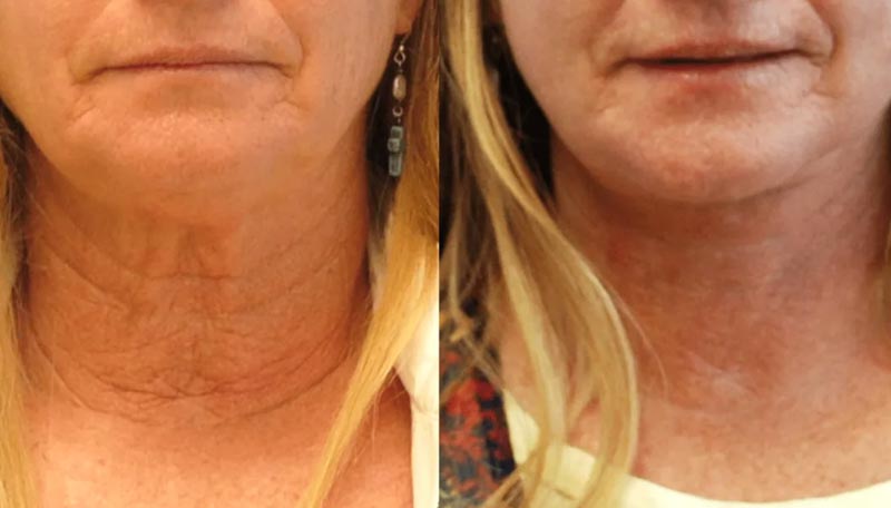 Prima e dopo trattamento viso con Spirulipo 2x49.