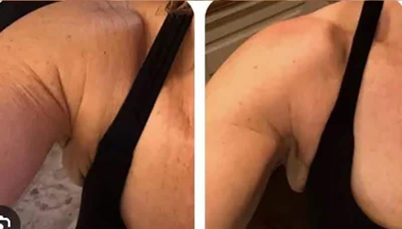 Dimagrimento visibile con Spirulipo 2x49, confronto prima e dopo.