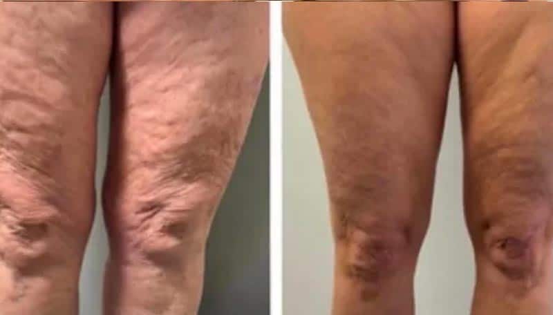 Prima e dopo trattamento cellulite sulle gambe.